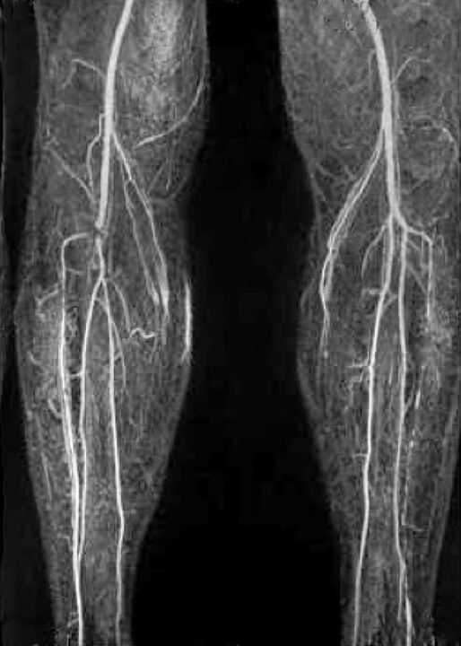 Αγγειακή x -Ray