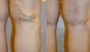 σημεία και συμπτώματα των κιρσών στα πόδια στους άνδρες