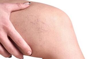 στάδια ανάπτυξης κιρσών