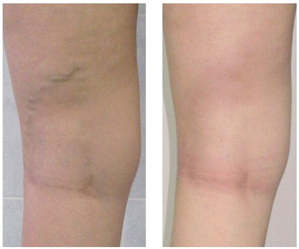 φλέβα στο πόδι πριν και μετά τη θεραπεία των κιρσών