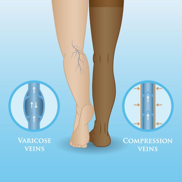 Επιδράσεις των ενδυμάτων συμπίεσης στις κιρσούς στα πόδια