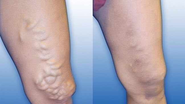 Πόδια πριν και μετά τη θεραπεία σοβαρών κιρσών