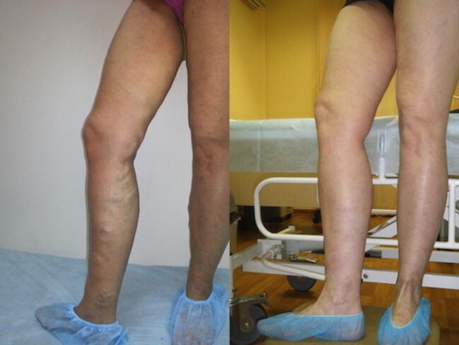 Πόδια πριν και μετά τη θεραπεία των κιρσών με λέιζερ